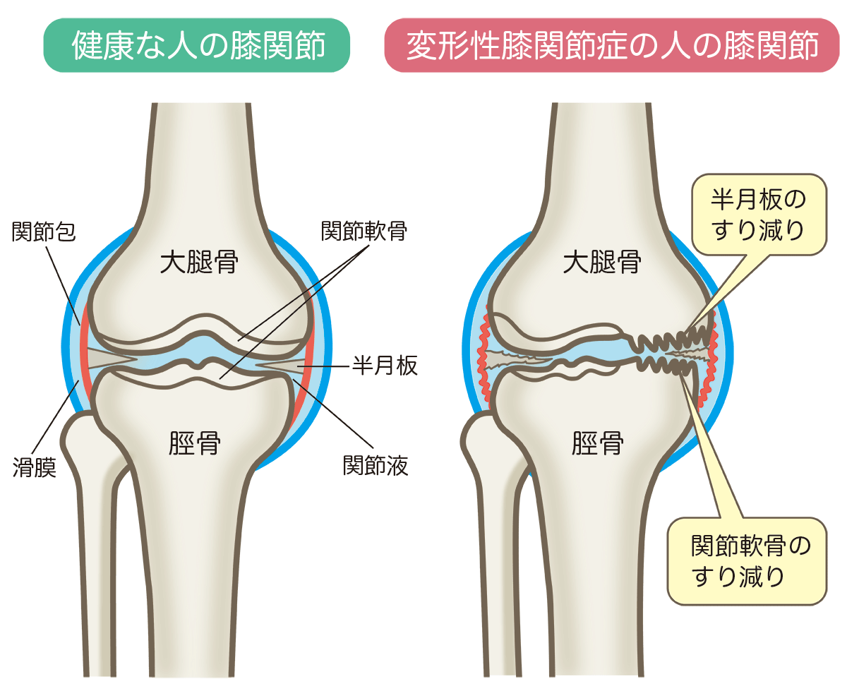 膝関節症センター(変形性膝関節症:OA) | よこい整形外科健康スポーツ